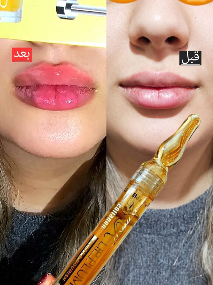 حجم‌دهنده لب کلاژن - Image 2