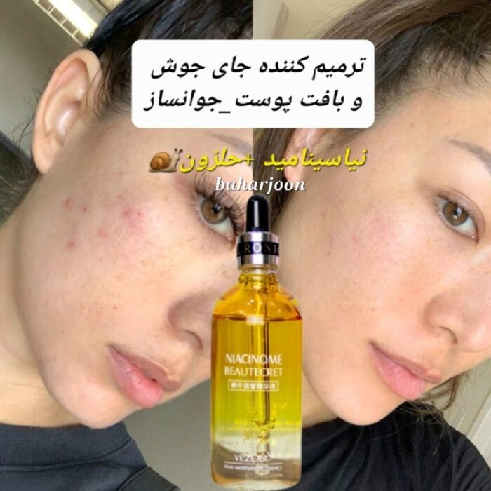 جای جوش لکه جای جوش سرم ضدلک سرم برای جای جوش سرم ترمیم کننده